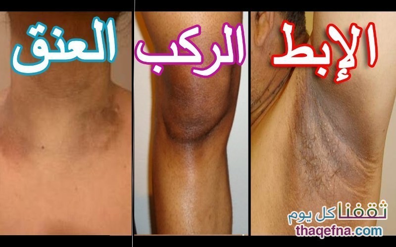 أسهل وصفة للتخلص من سواد الإبط والرقبة والركبتين والكوعين وتفتيح المناطق السوداء بالجسم!!