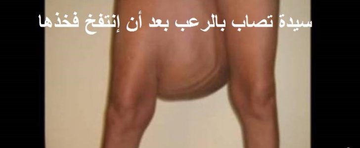 شاهدوا بالفيديو سيدة تصاب بالرعب بعد أن إنتفخ فخذها بشكل مرعب ….. وماذا وجدوا به؟