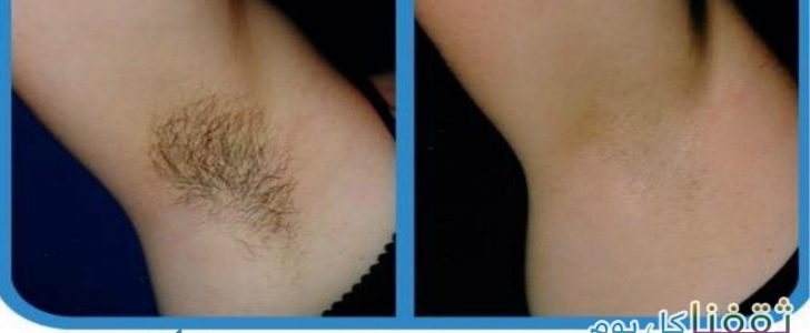 أفضل طريقة لإزالة الشعر من الإبطين والمنطقة الحساسة بدون ألم ويقلل من نمو الشعر