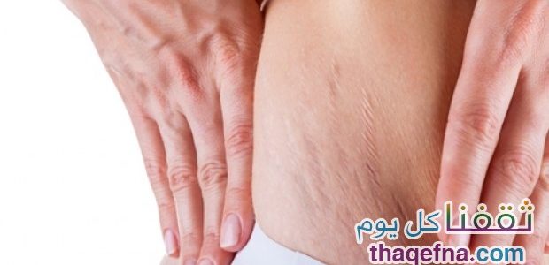 أصبح التخلص من تشققات الجلد بطريقة سهلة جداً مع خلطتنا الطبيعية السحرية
