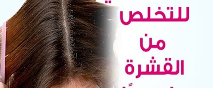 أفضل وصفة طبيعية للتخلص من قشرة الرأس في خلال يوم واحد فقط والنتائج مضمونة