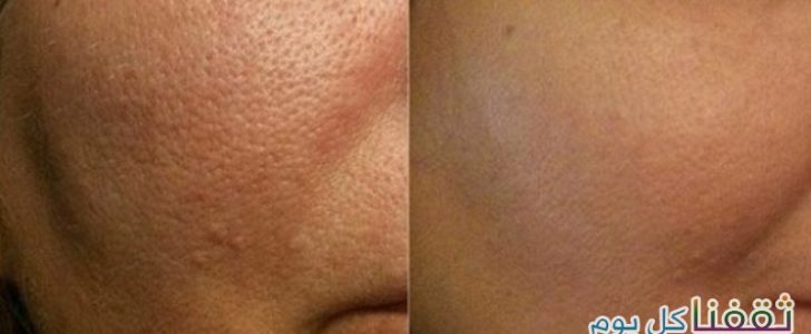 وصفة بسيطة من مكونين بسيطين من أجل التخلص من المسامات الواسعة في الوجه