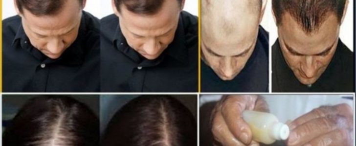 أفضل قناع طبيعي لإنبات الشعر والتخلص من الصلع وبدون آثار جانبية وبنتائج مذهلة !