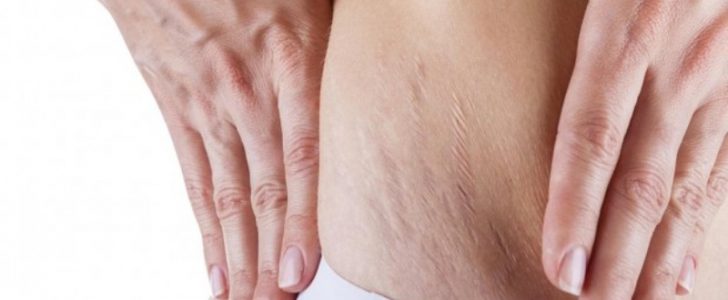 أفضل طريقة طبيعية من أجل التخلص من علامات تمدد الجلد وتشققات منطقة البطن