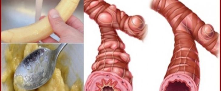 أفضل وصفة طبيعية ومنزلية من أجل علاج إلتهاب الشعب الهوائية وبنتائج سريعة