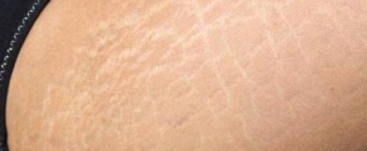 علاج الخطوط البيضاء …. الناتجة عن تمدد الجلد خاصة عند النساء واسباب ظهورها