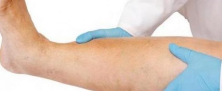 التخلص من دوالي الساقين مع أفضل علاج طبيعي ونتائج سريعة مع خل التفاح