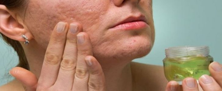 أفضل العلاجات الطبيعية للتخلص من حب الشباب والحصول على بشرة صافية !