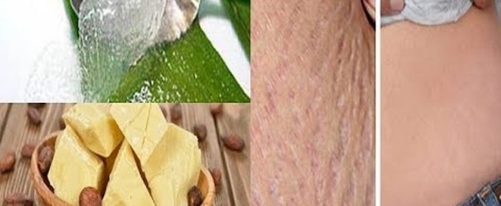 تعرفي معنا على أفضل الطرق الطبيعية من أجل التخلص من علامات تمدد الجلد في منطقة البطن بعد الولادة !