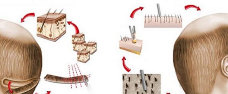 أحدث تقنيات زراعة الشعر تقنية الشريحة FUT و تقنية الاقتطاف FUE !
