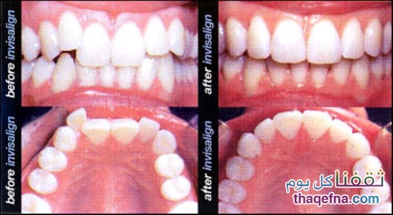 أسباب تزاحم الاسنان