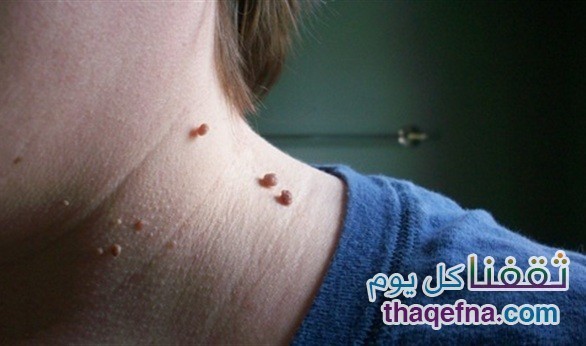 حصريا لكي يا سيدتي الطريقة الفعالة من اجل التخلص من الزوائد الجلدية .. الحلم تحقق بطريقة بسيطة جدا
