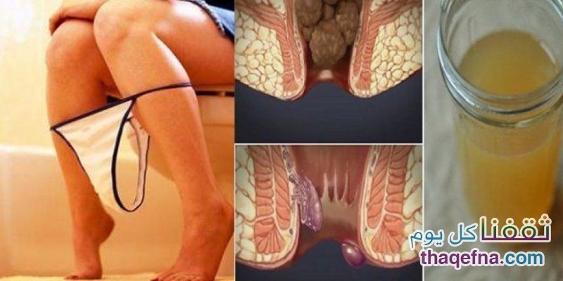 التخلص من البواسير خلال 24 ساعة فقط بإستخدام مكون بسيط وموكود في كل منزل!!