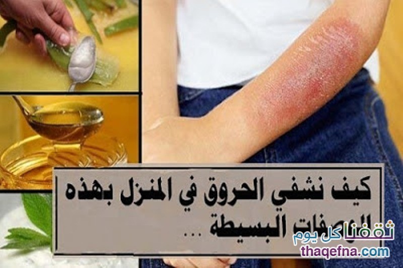 التخلص من آلام الحروق ومن آثارها بوصفات طبيعية وبسرعة كبيرة ومجربة ومتوفرة بالمنزل