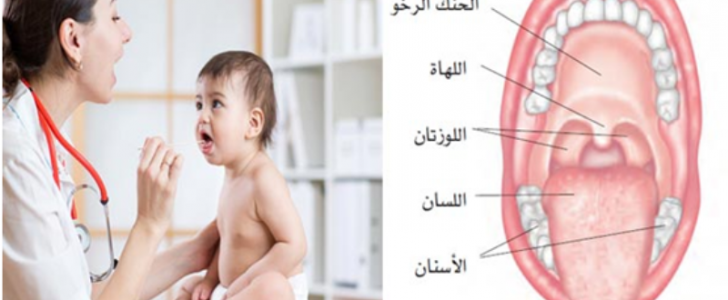 التهاب اللوزتين عند الأطفال الأسباب وطرق العلاج