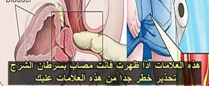 إحذروا من هذه العلامات فهي دليل على وجود سرطان الشرج